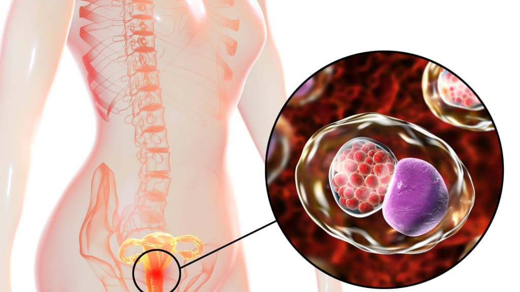 Conheça a Doença Inflamatória Pélvica e seus perigos para a saúde feminina
